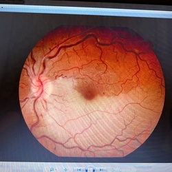 Retina