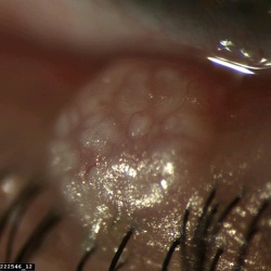 Eyelid 