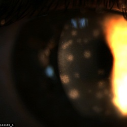 Conjunctiva