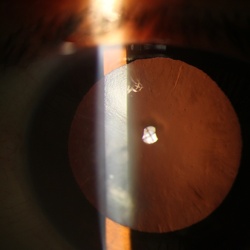 Cataract and IOLs