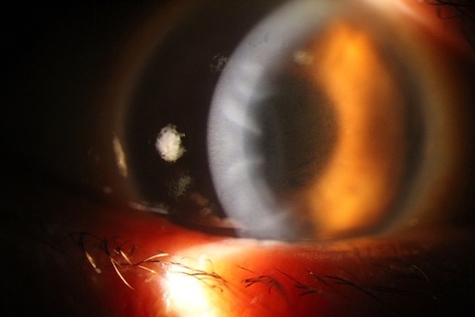 Corneal Edema with Descemet Membrane Folds