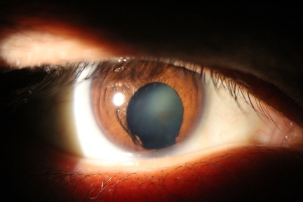 Iris coloboma with nuclear cataract